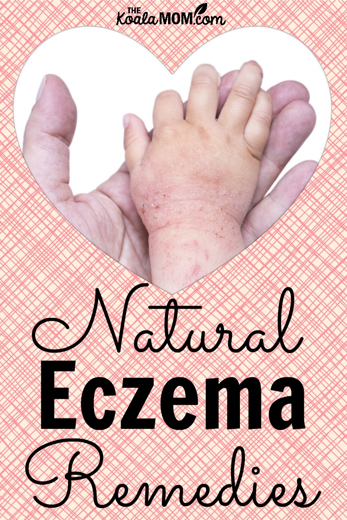 Natural eczema remedies (adult holding a child's hand with eczema)