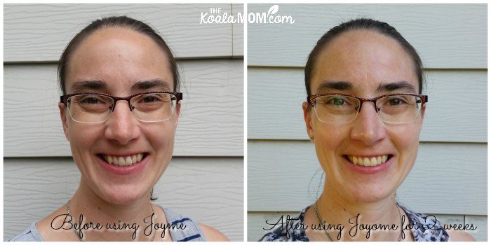 Before and after pictures from using the Joyome Essentials Skincare collection.