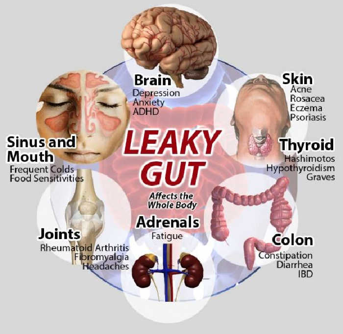 Symptoms of Leaky Gut.